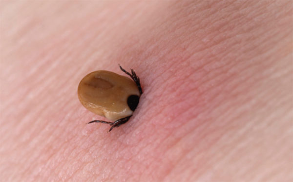 Lyme Disease > Symptoms | Transmission | Diagnosis | Treatment | Prevention